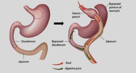 Obesity is associated with GERD